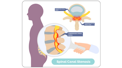 spondylitis treatments