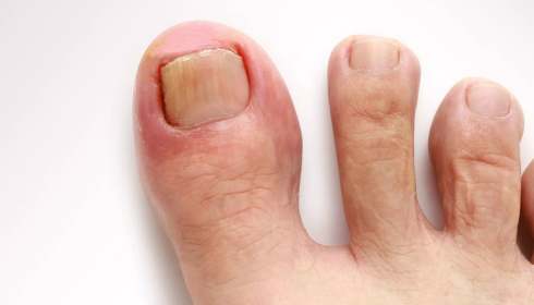 ingrown toenail removal near me